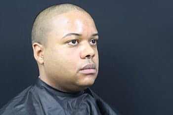 Dermal Fillers Before & After