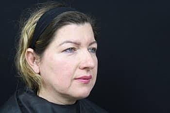 Dermal Fillers Before & After