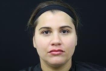 Dermal Fillers Before & After