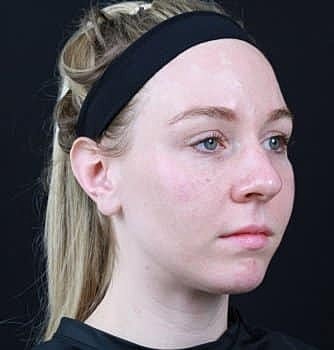 Dermal Fillers Before & After