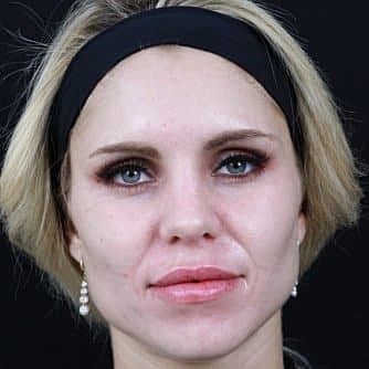 Dermal Fillers Before & After