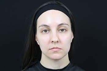 Dermal Fillers Before & After