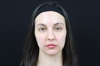 Dermal Fillers Before & After