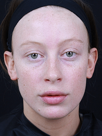 Dermal Fillers Before & After