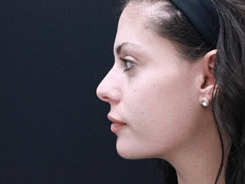 Dermal Fillers Before & After