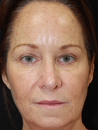 Dermal Fillers Before & After