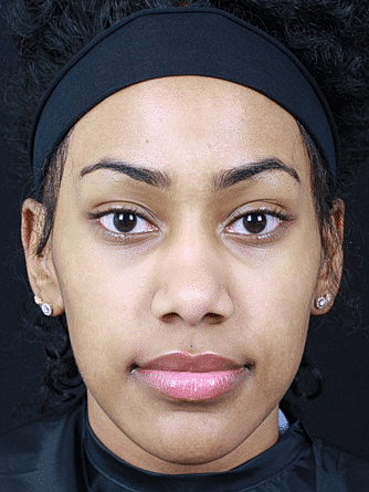 Dermal Fillers Before & After