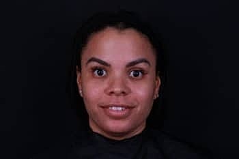 Botox & Dysport Before & After