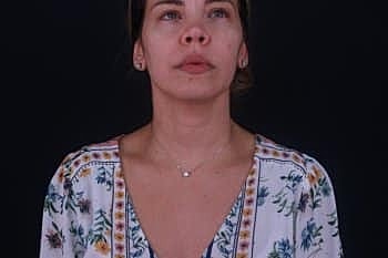 Botox & Dysport Before & After