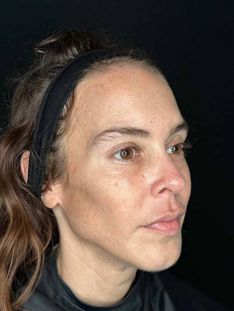 Botox & Dysport Before & After