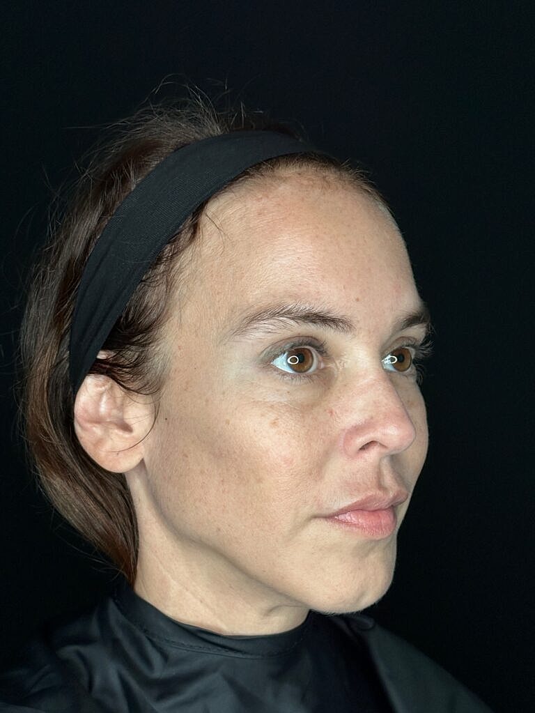 Botox & Dysport Before & After