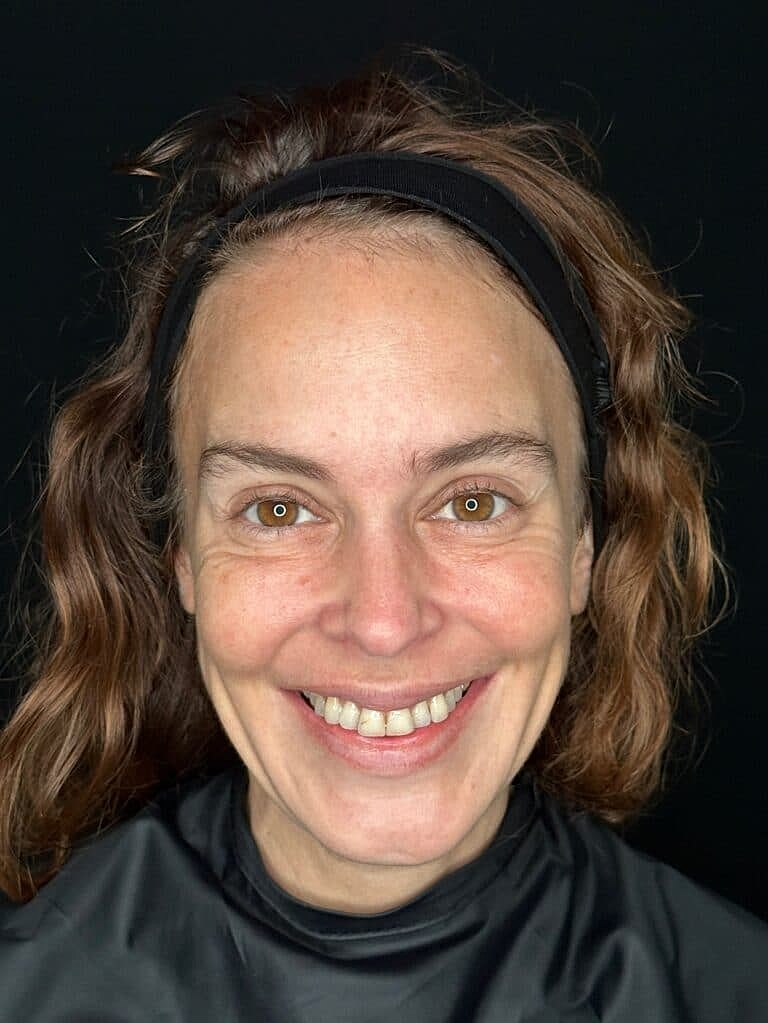 Botox & Dysport Before & After