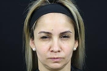 Botox & Dysport Before & After