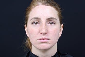 Botox & Dysport Before & After