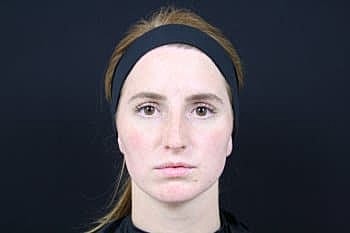 Botox & Dysport Before & After