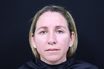 Botox & Dysport Before & After