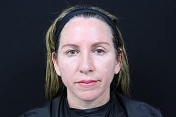 Botox & Dysport Before & After