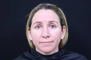 Botox & Dysport Before & After