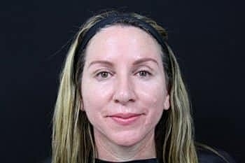 Botox & Dysport Before & After