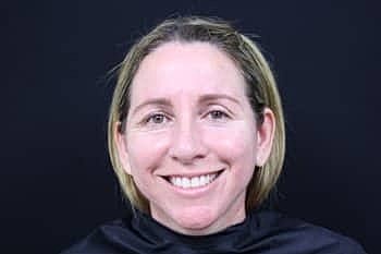 Botox & Dysport Before & After