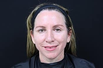 Botox & Dysport Before & After