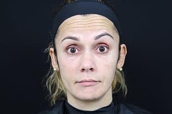 Botox & Dysport Before & After