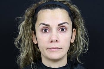 Botox & Dysport Before & After