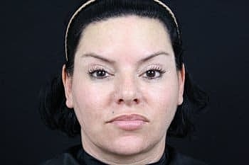 Botox & Dysport Before & After