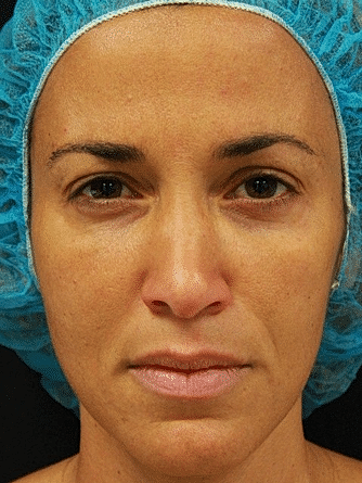 Botox & Dysport Before & After