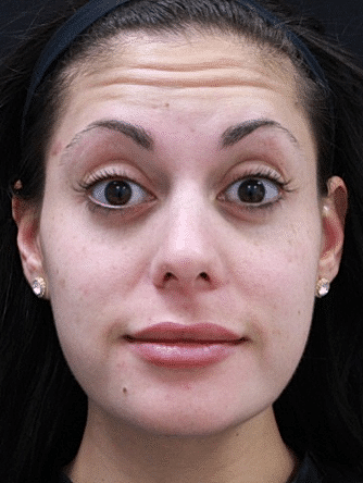 Botox & Dysport Before & After