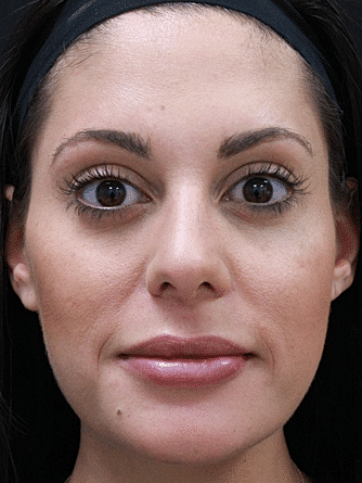 Botox & Dysport Before & After