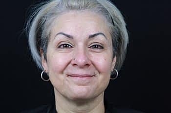 Botox & Dysport Before & After