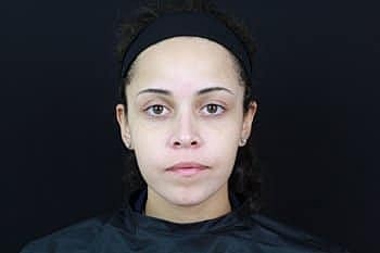 Botox & Dysport Before & After