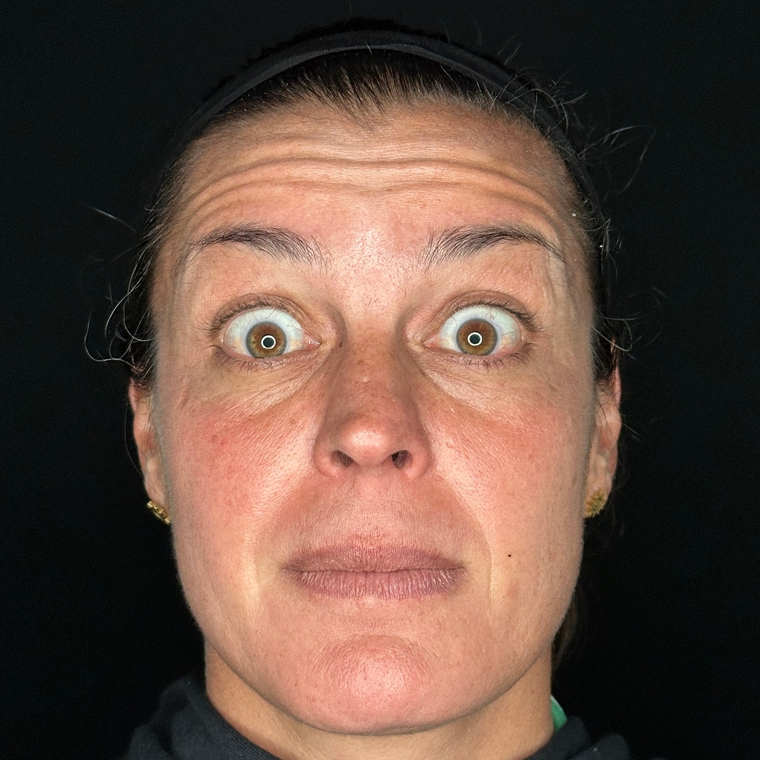 Botox Before & After