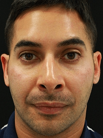 Botox & Dysport Before & After