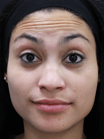 Botox & Dysport Before & After