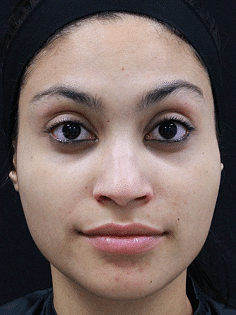 Botox & Dysport Before & After