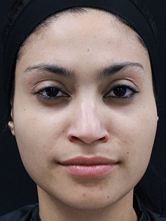 Botox & Dysport Before & After