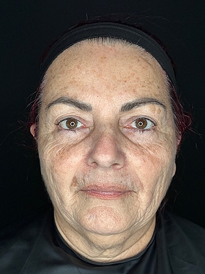 Botox & Dysport  Before & After