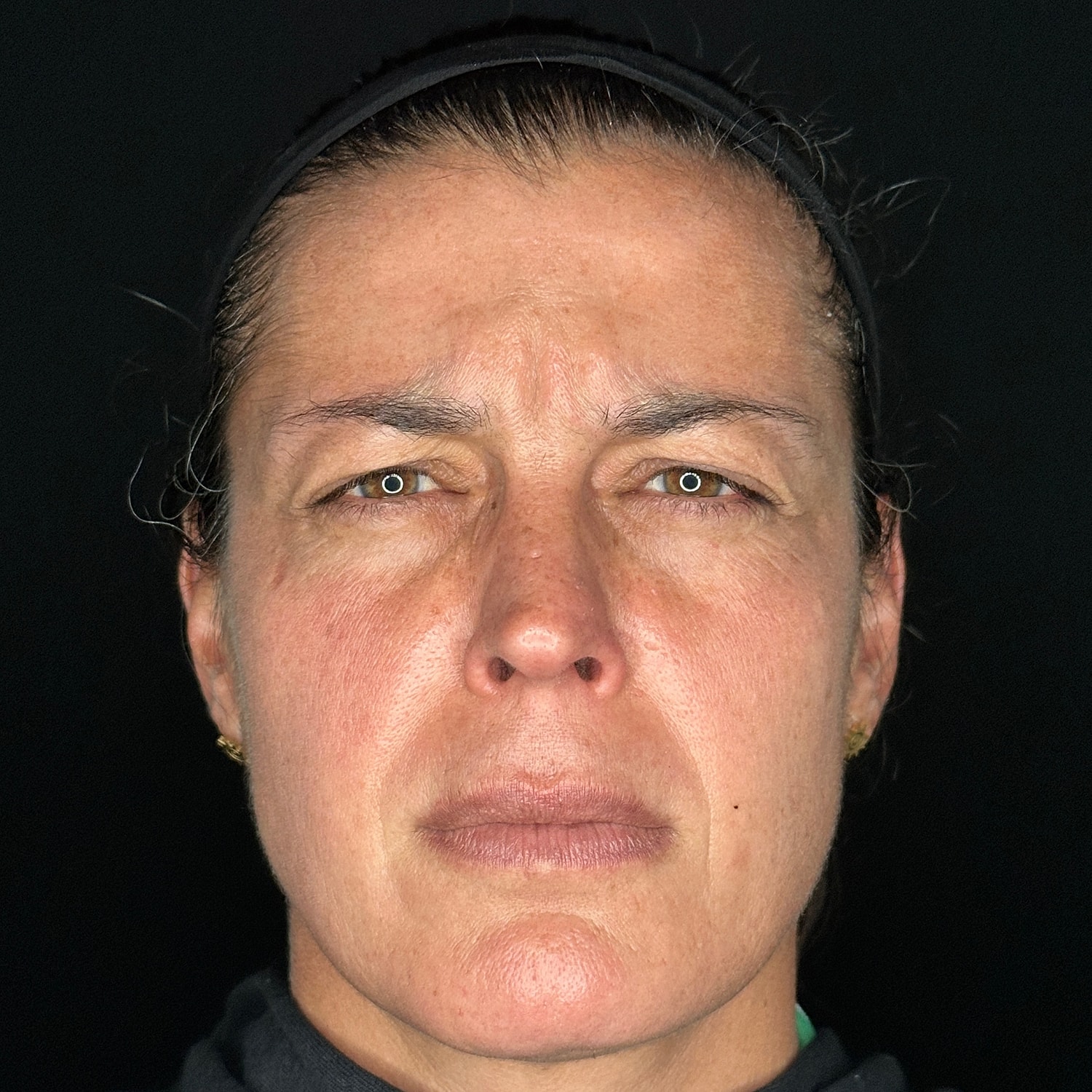 Botox Before & After