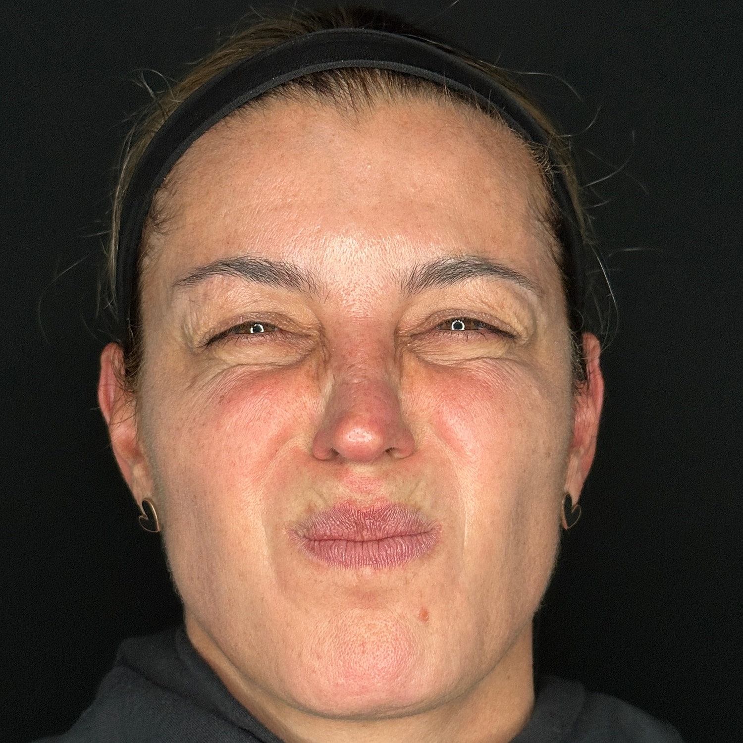 Botox Before & After