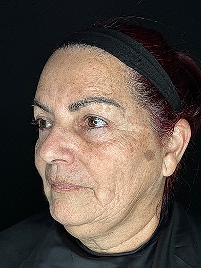 Profile of a woman with facial wrinkles.