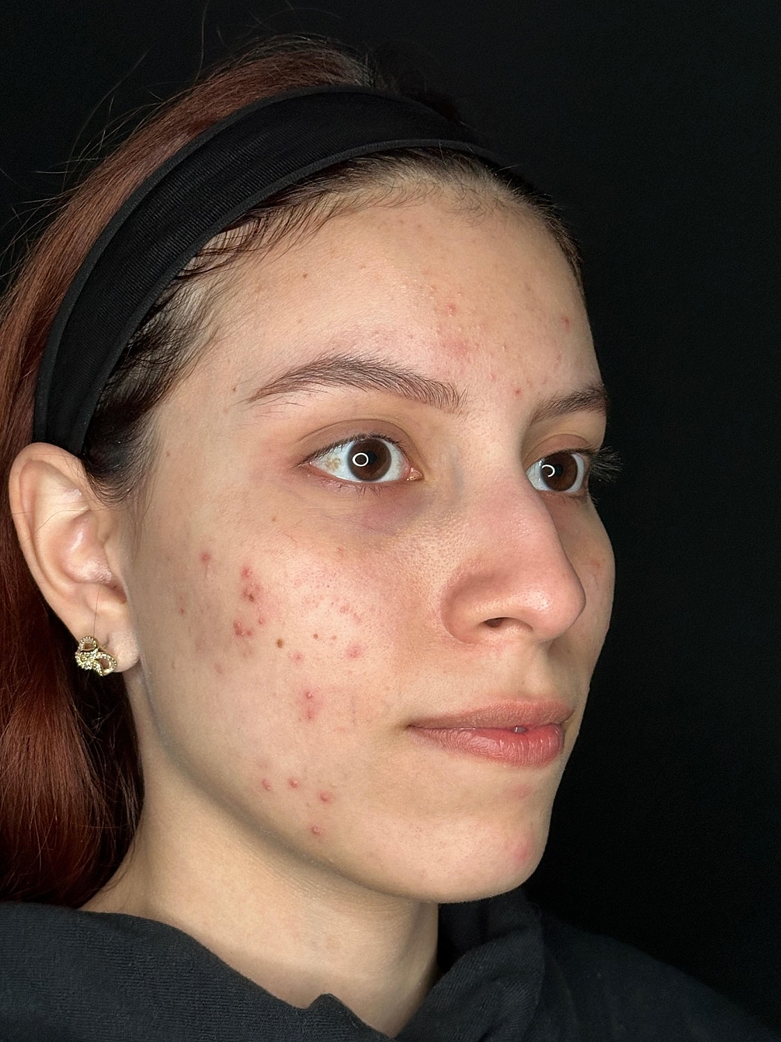 IPL Before & After