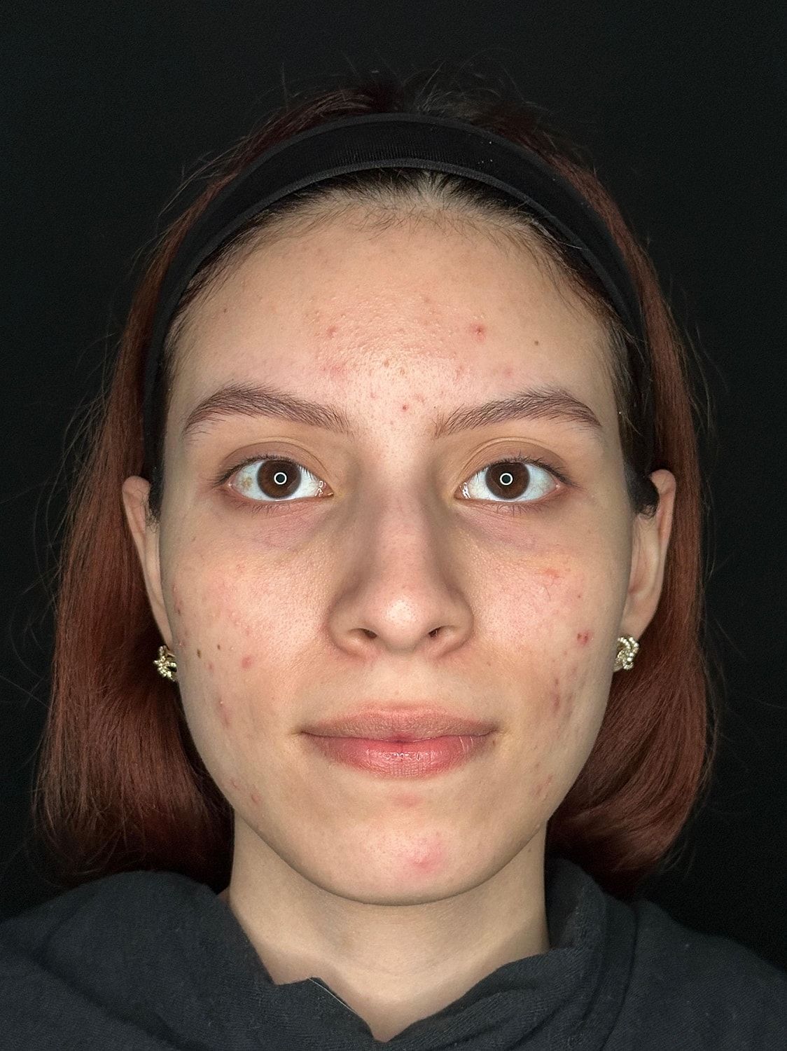 IPL Before & After