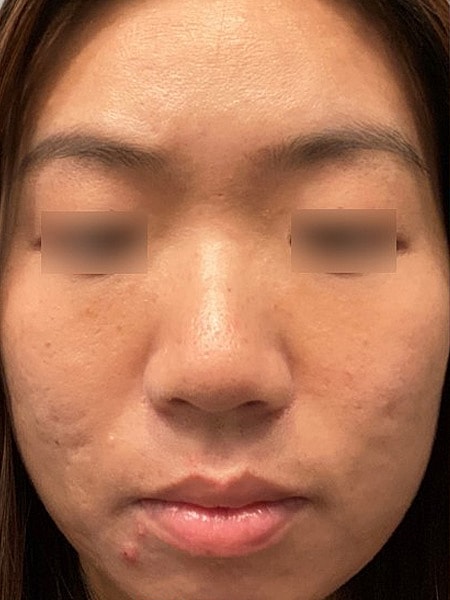 UltraClear Before & After