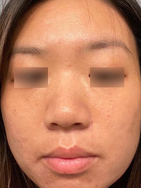 UltraClear Before & After