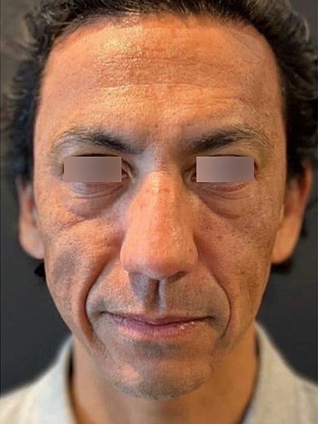 UltraClear Before & After
