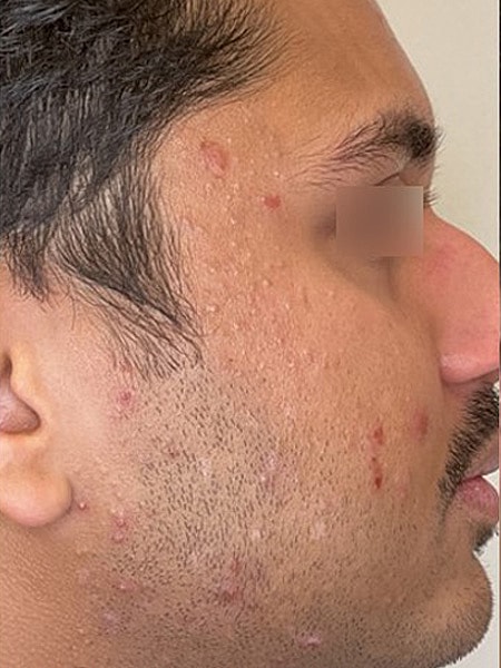UltraClear Before & After