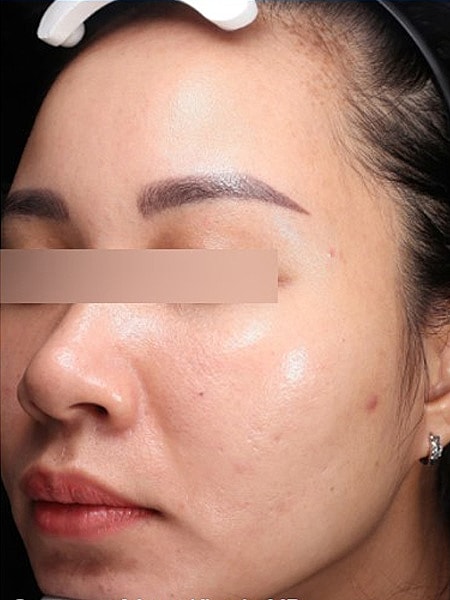 UltraClear Before & After