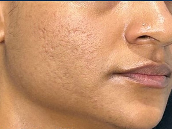 UltraClear Before & After